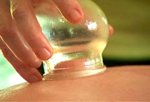 Brillante Instalación Sospechar Ventosas o Cupping | Apiterapia, Acupuntura y Naturopatía