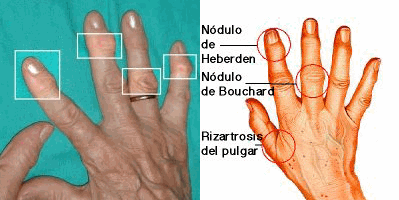 artrosis en las manos, tratamiento con apiterapia, acupuntura y naturopatía