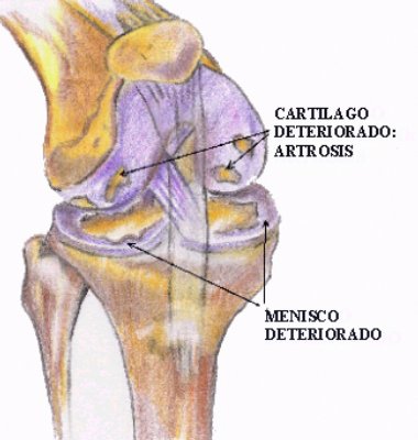 tratamiento de artrosis en rodilla