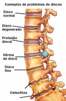 Tratar discopatías con apiterapia acupuntura y naturopatía