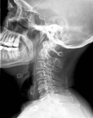 tratar Espondiloartrosis cervical