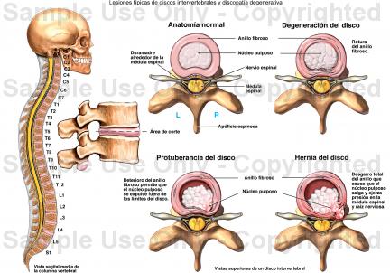 tratar lesiones discales con apiterapia acupuntura y naturopatia